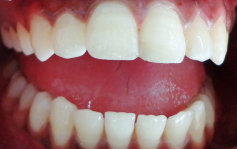 img-filling-after